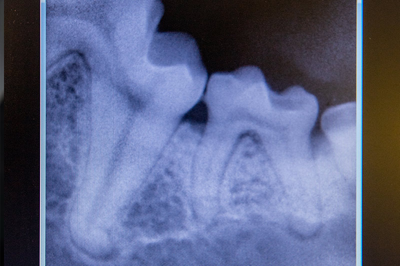 dentale rontgenfoto tandheelkunde gebitsbehandeling